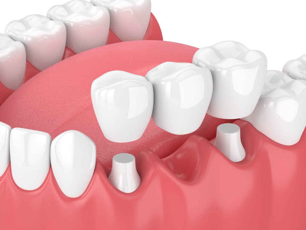 dental bridge in Huntsville, TX